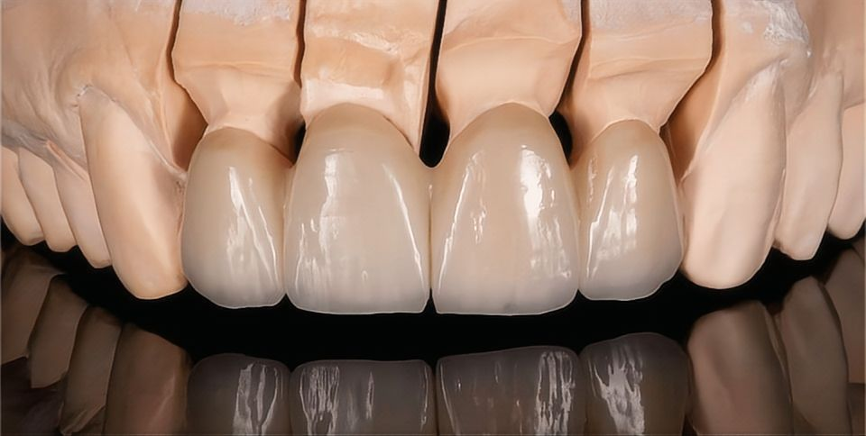 ເຮືອນຍອດເຊລາມິກ & Zirconia