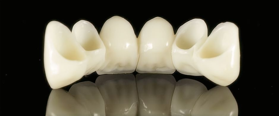 ເຮືອນຍອດເຊລາມິກ & Zirconia