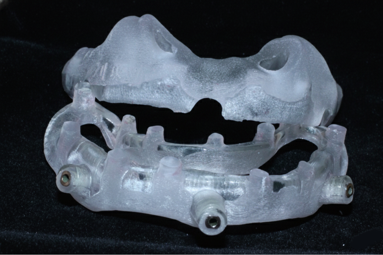 What Is a Digital Surgical Guide? – Introduction to Guided Implant Surgery
