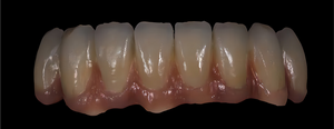 Corone interamente in ceramica e zirconio