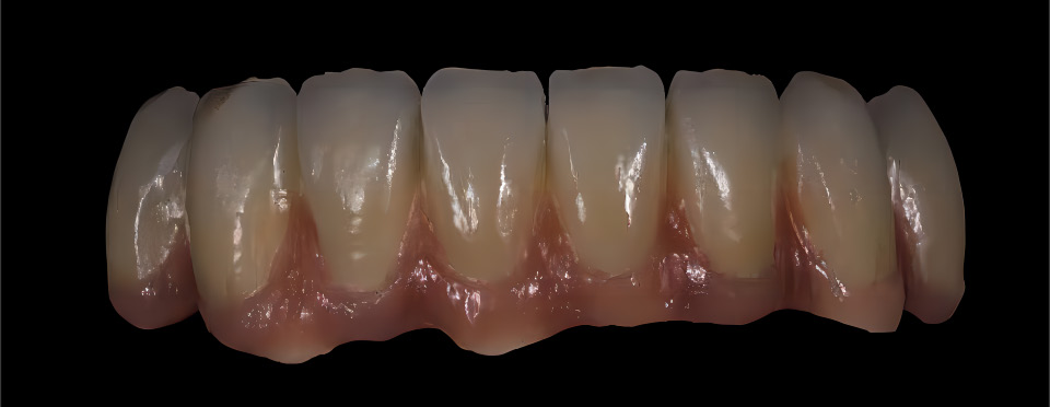 ເຮືອນຍອດເຊລາມິກ & Zirconia